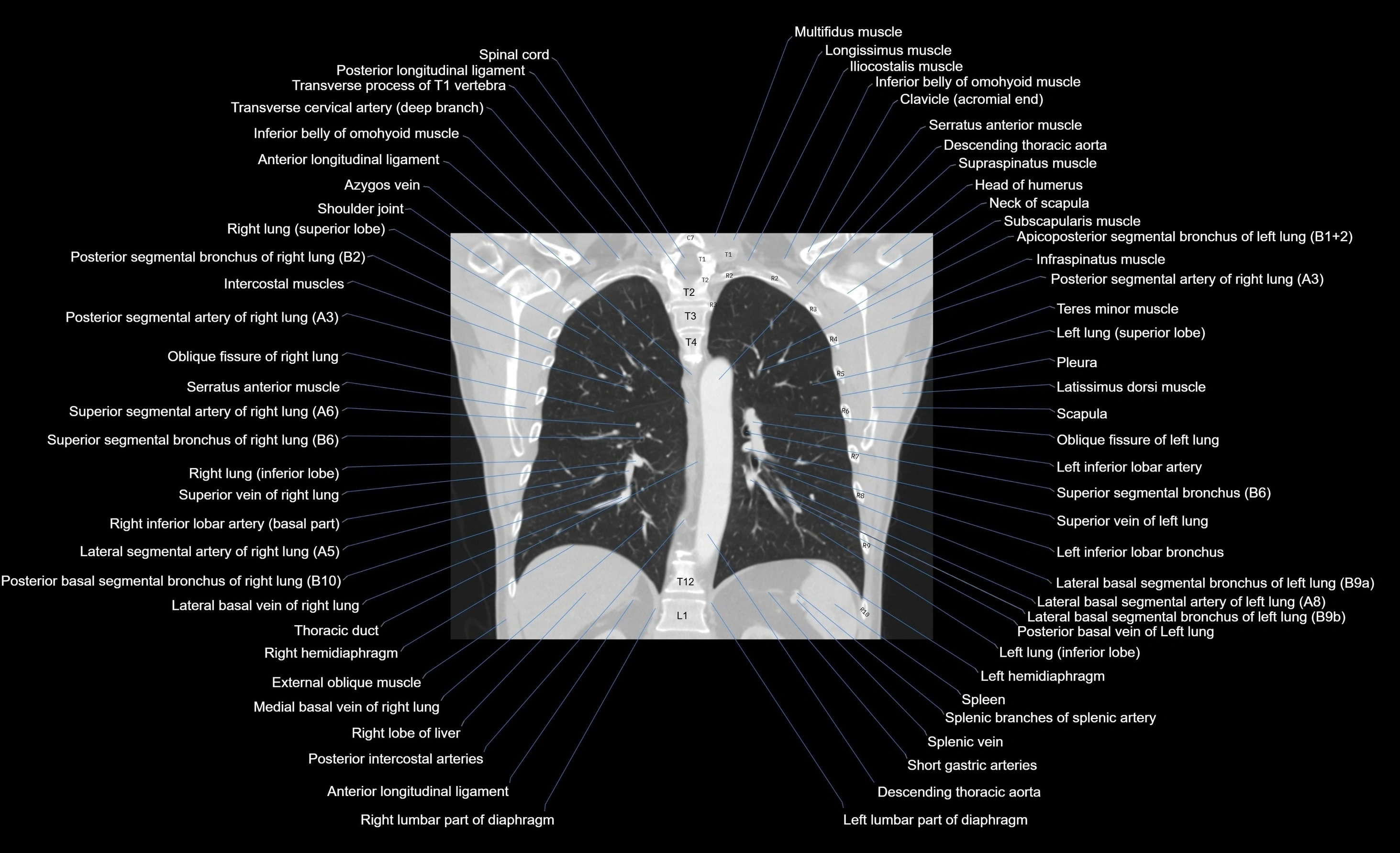 CT chest (thorax) lung window window labelled coronal cross sectional anatomy radiology image-00046.webp